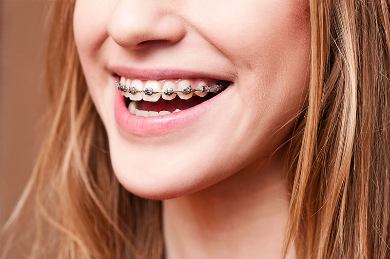 Orthodontics in Bolingbrook