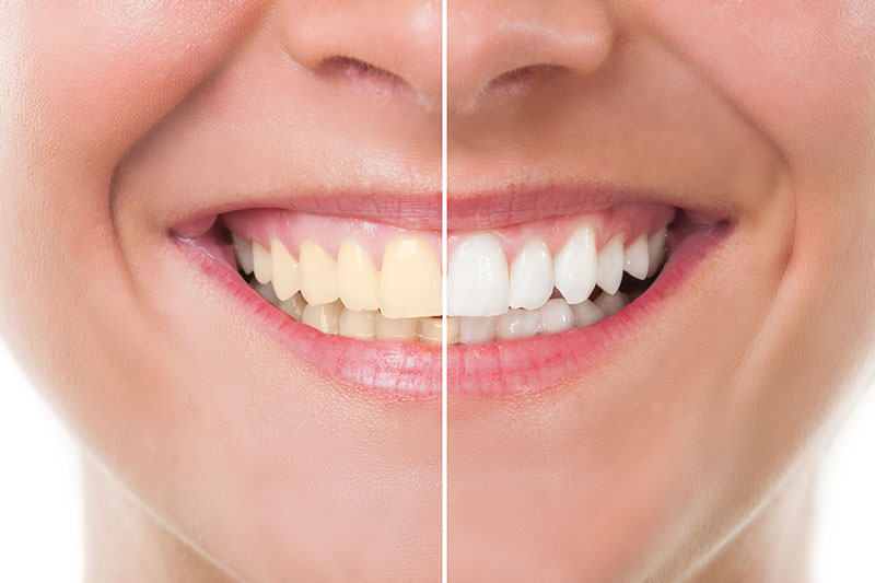 Teeth Whitening in Bolingbrook